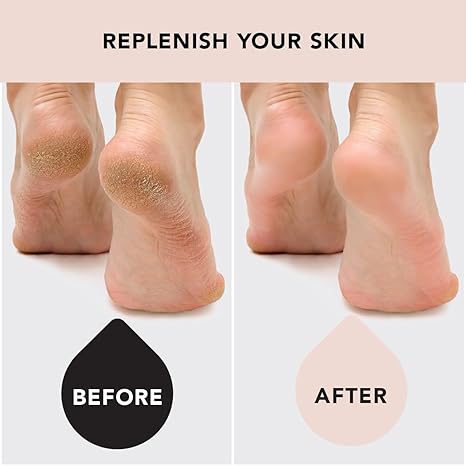 Kitsch Moisturizing Socks for Cracked Heel Treatment